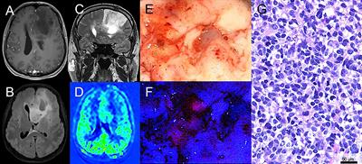 5-ALA in Suspected Low-Grade Gliomas: Current Role, Limitations, and New Approaches